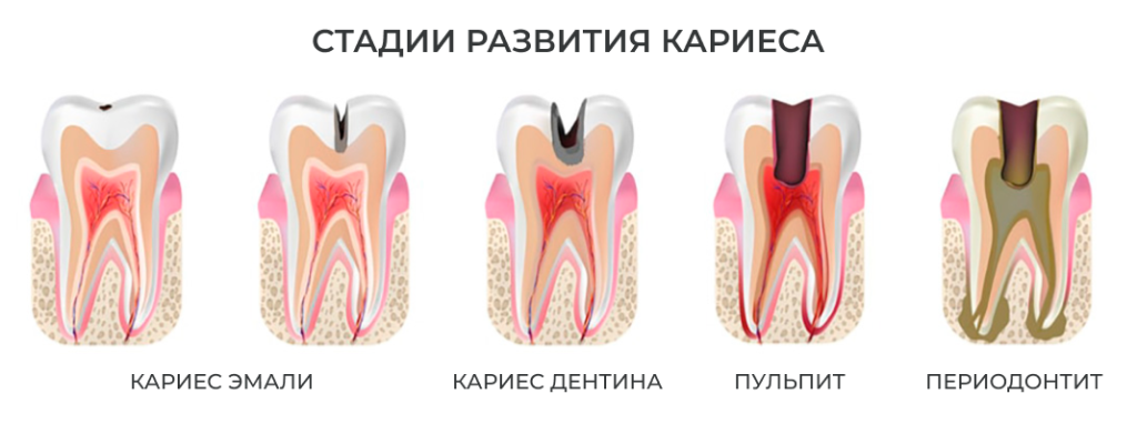стадии кариеса