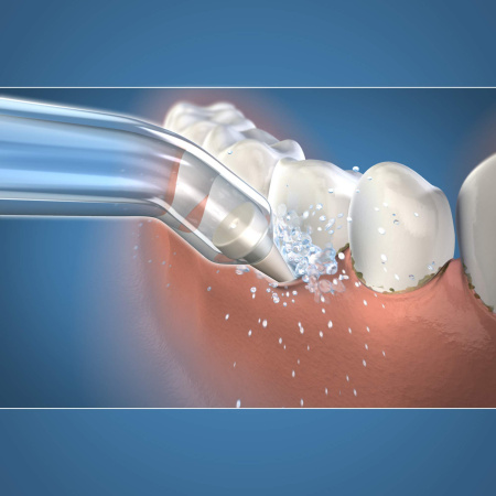 Пародонтологические насадки для ирригатора WaterPik PP-70E (2 шт)