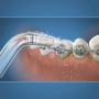 Ортодонтические насадки для ирригаторов WaterPik OD-100E (2 шт)